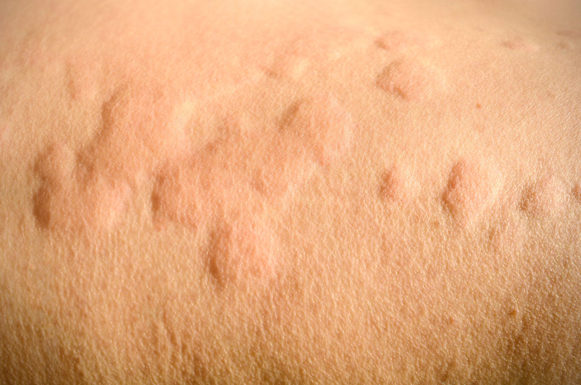 An up close photograph of raised hives on yellow-pink skin.