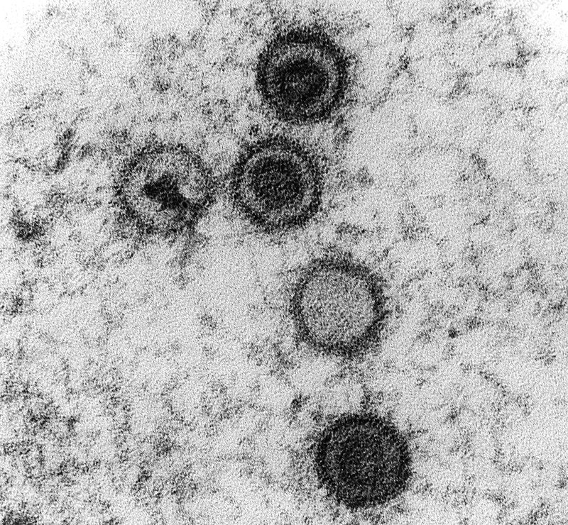  A transmission electron micrograph of Epstein-Barr viruses in Burkitt's lymphoma, seen as 5 circles with central, dark staining nucleic acid (DNA). Each circle has a dark outer ring and dark inner circle except one which only has a dark outer ring.