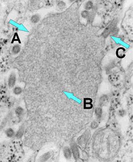 An electron microscopy depicting rabies virus particles budding from an inclusion into the endoplasmic reticulum in a nerve cell. Three arrows point 'A' = Negri body. 'B' = abundant RNP in the inclusion. 'C' = budding rabies virus.