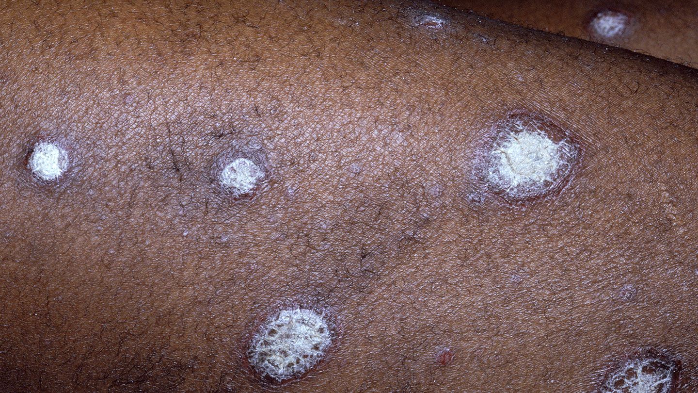 An upclose color photograph of white circular lesions on brown skin.